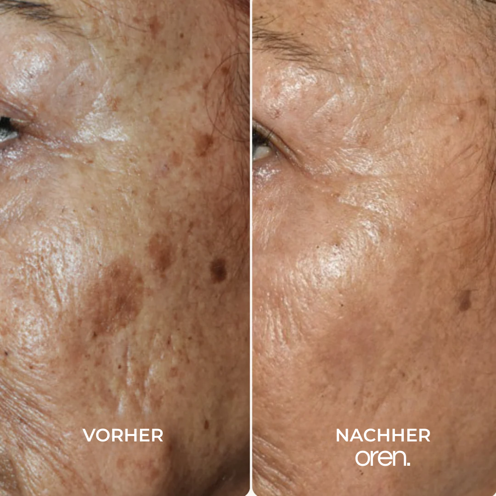 OREN Korrektur-Serum für dunkle Flecken