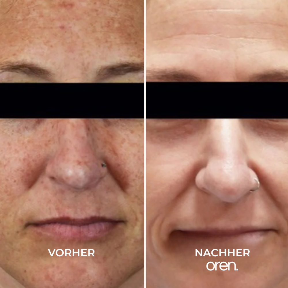 OREN Korrektur-Serum für dunkle Flecken