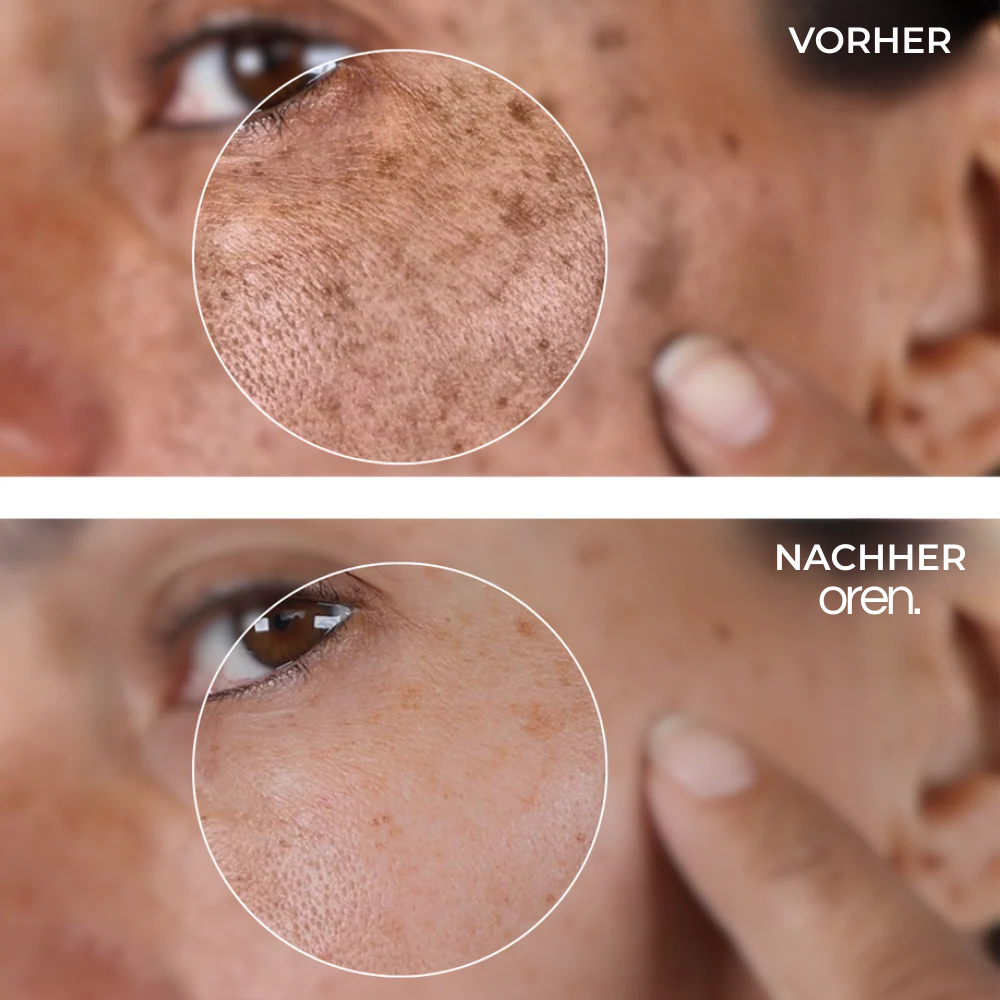 OREN Korrektur-Serum für dunkle Flecken